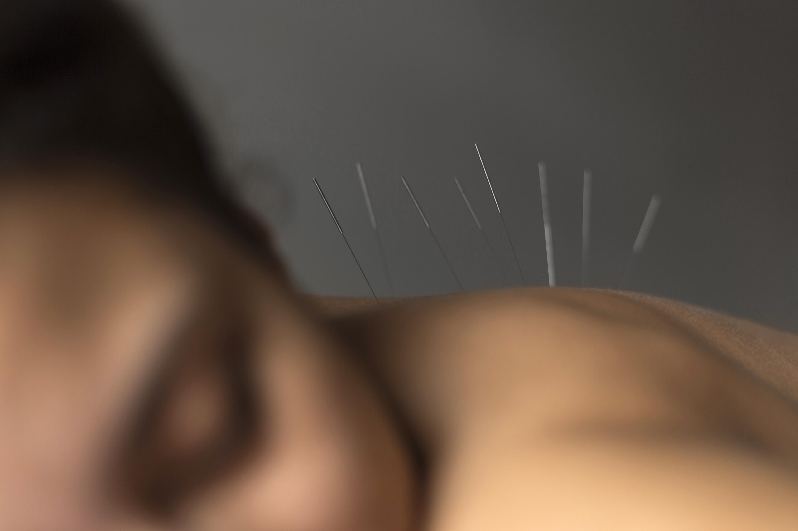 close-up-patient-acupuncture-procedure